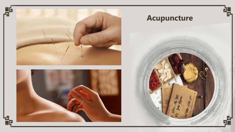 Acupuncture is a family of procedures that stimulate specific points on the body by inserting extremely thin needles into the skin. It is often used to provide pain relief for conditions like lower back pain, shoulder stiffness, and knee soreness. Acupuncture must always be done by an appropriately trained practitioner using clean needles. (Photo/China Plus)